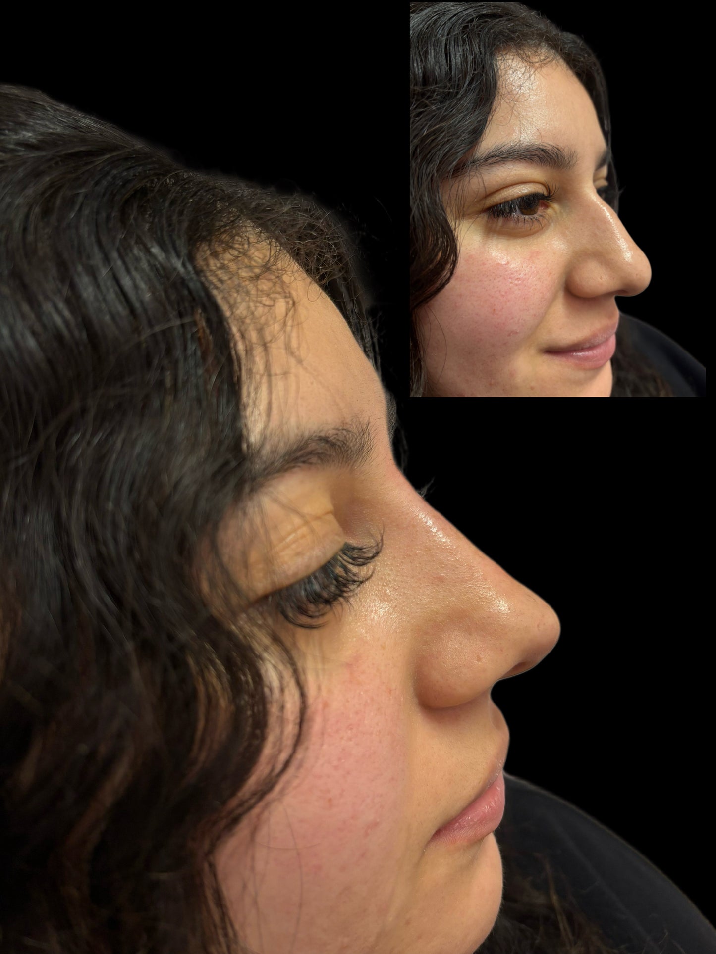 Nose filler Deposit