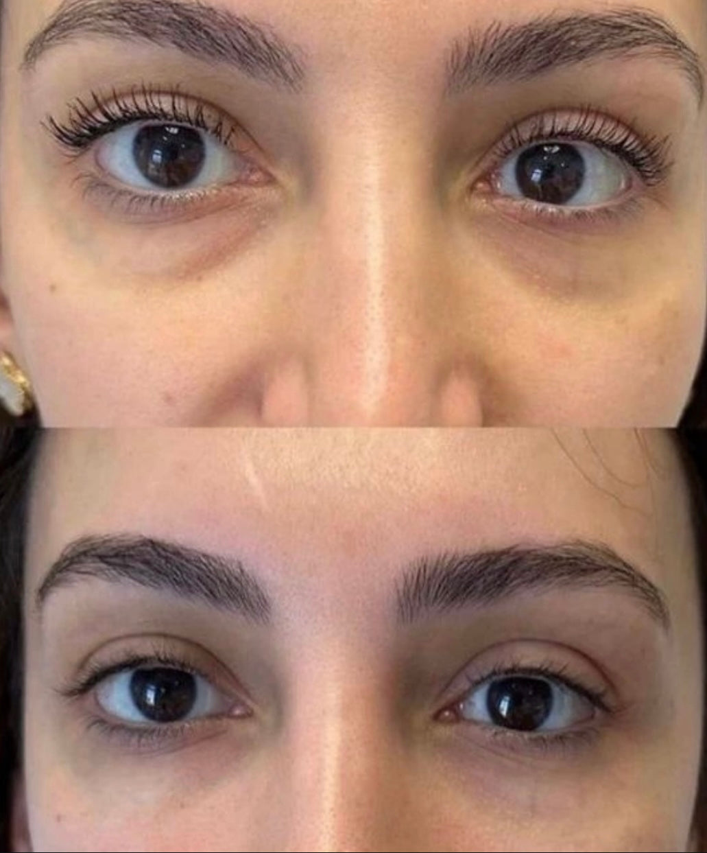 Under eye Filler Deposit