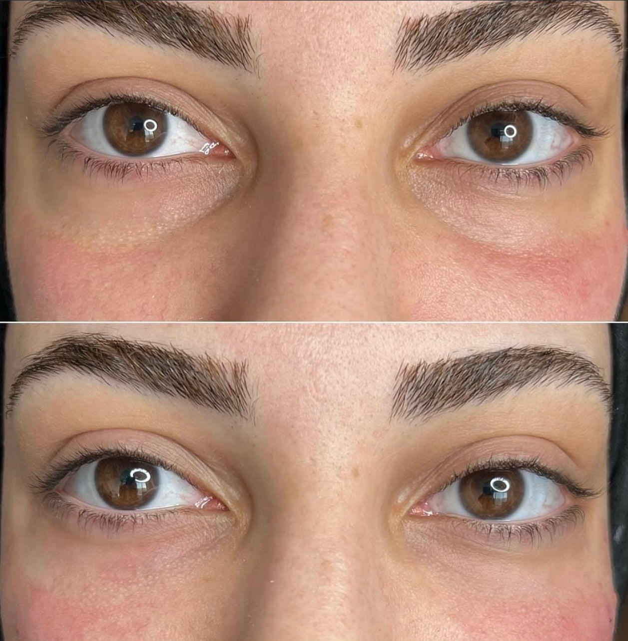 Under eye Filler Deposit