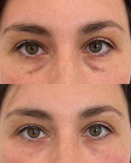 Under eye Filler Deposit