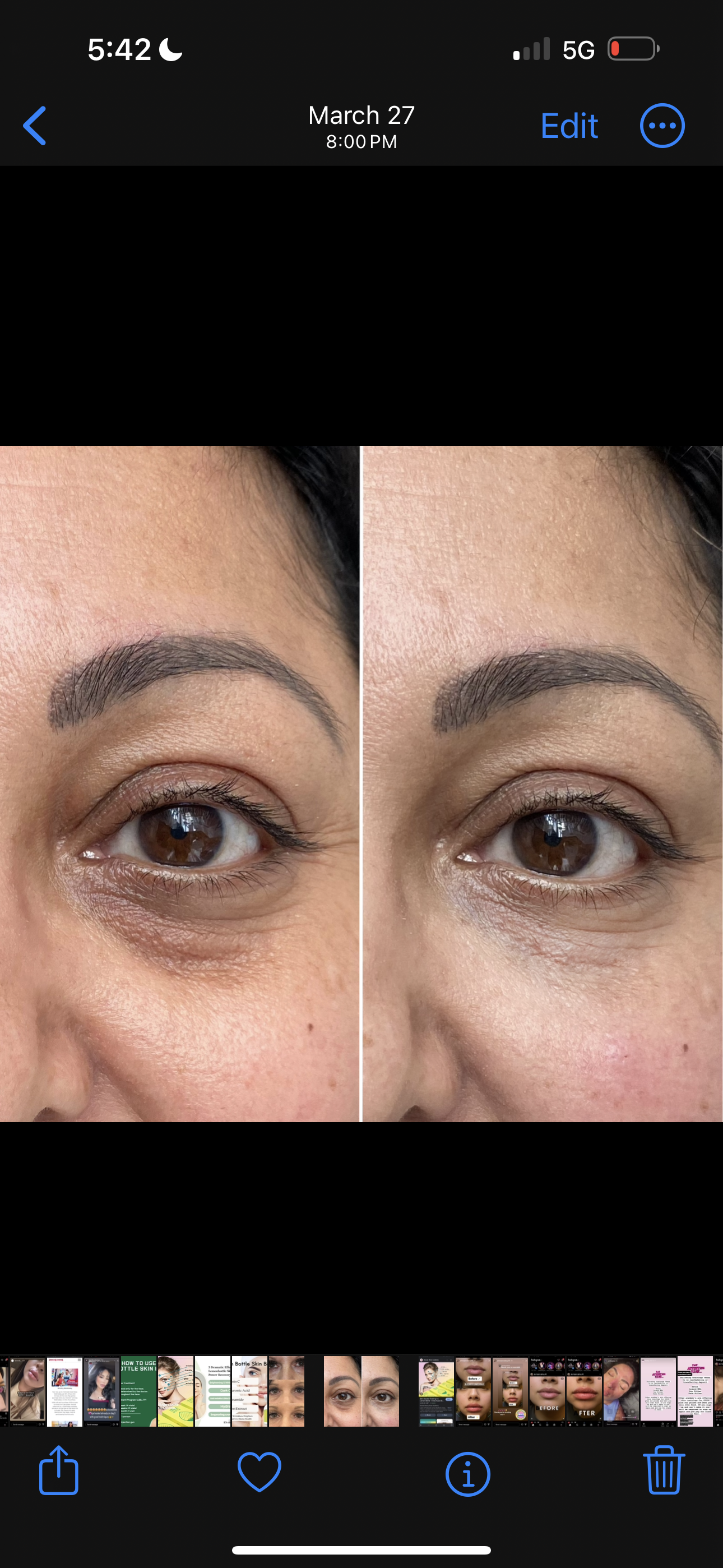 Under eye Filler Deposit