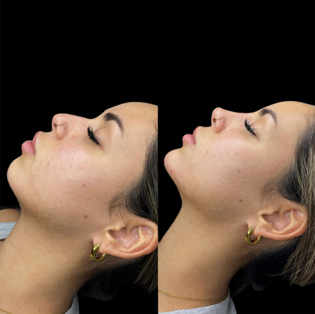 Facial Contouring Deposit