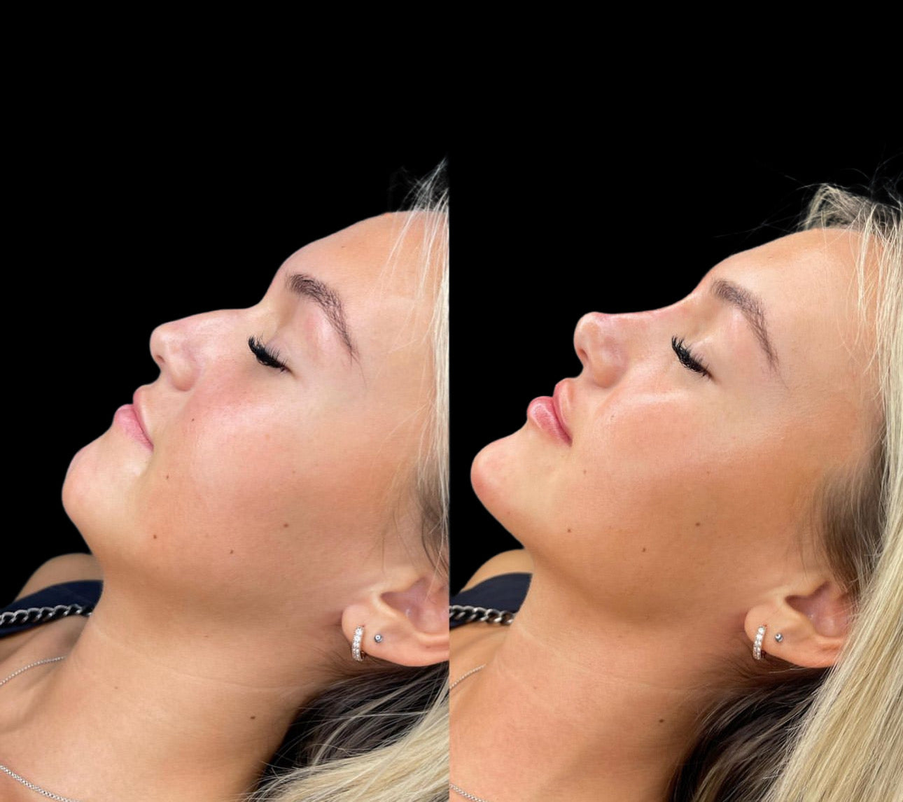 Facial Contouring Deposit