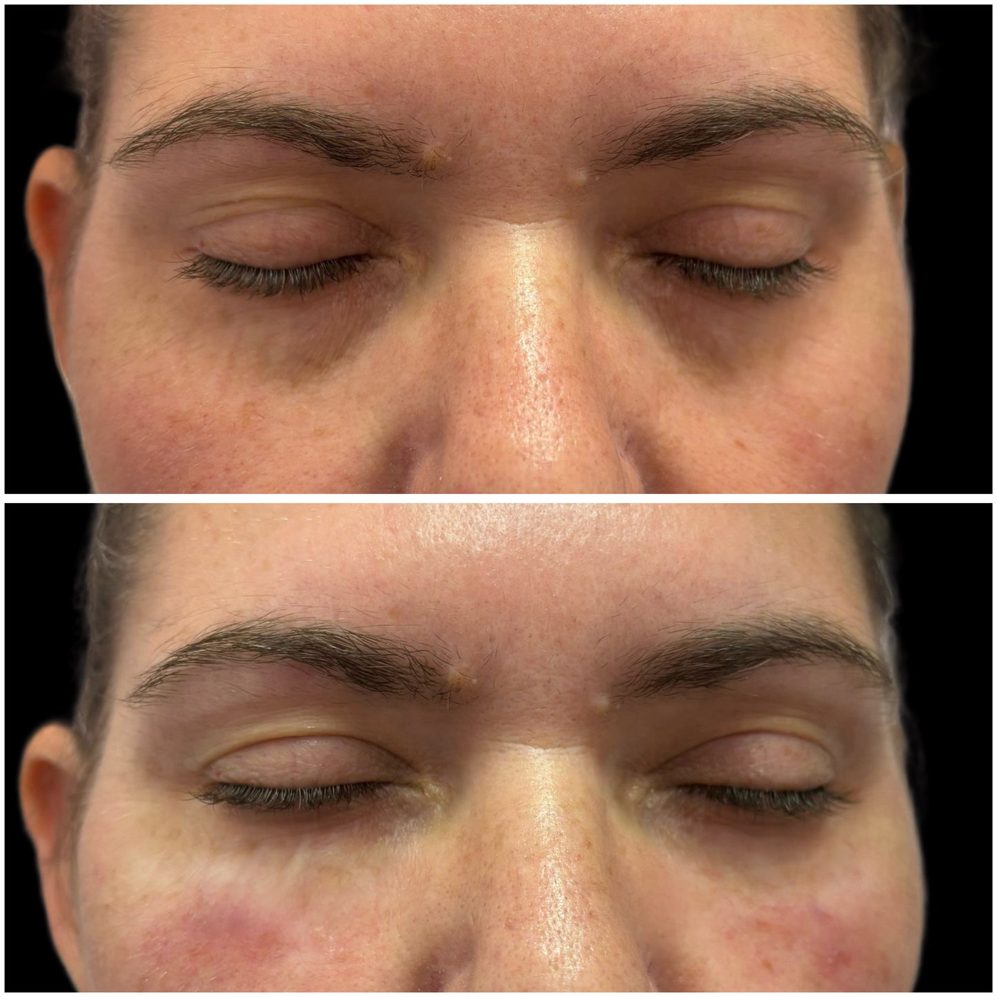 Under eye Filler Deposit