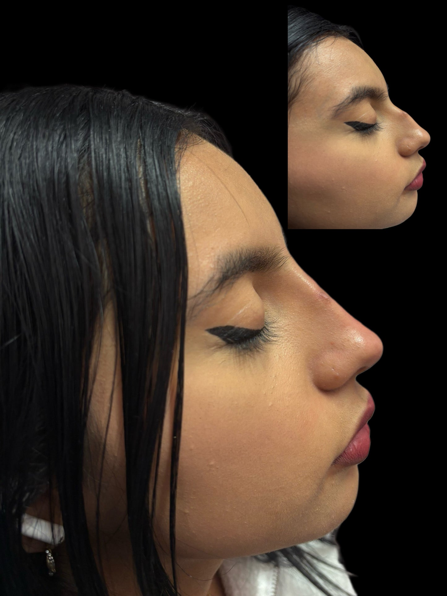 Nose filler Deposit