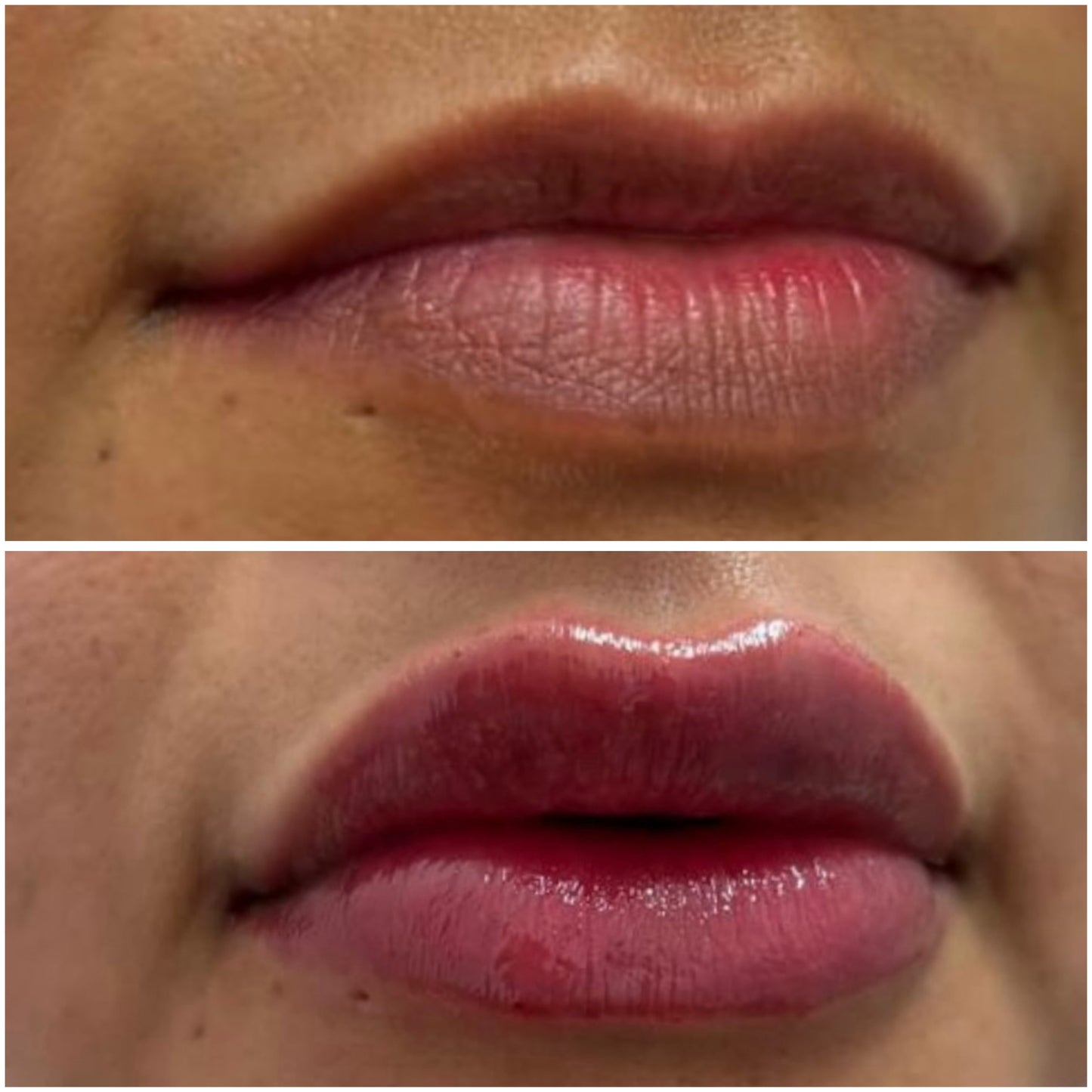 Lip Filler Deposit