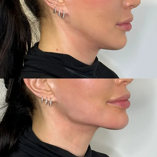 Jaw and Chin Filler Deposit