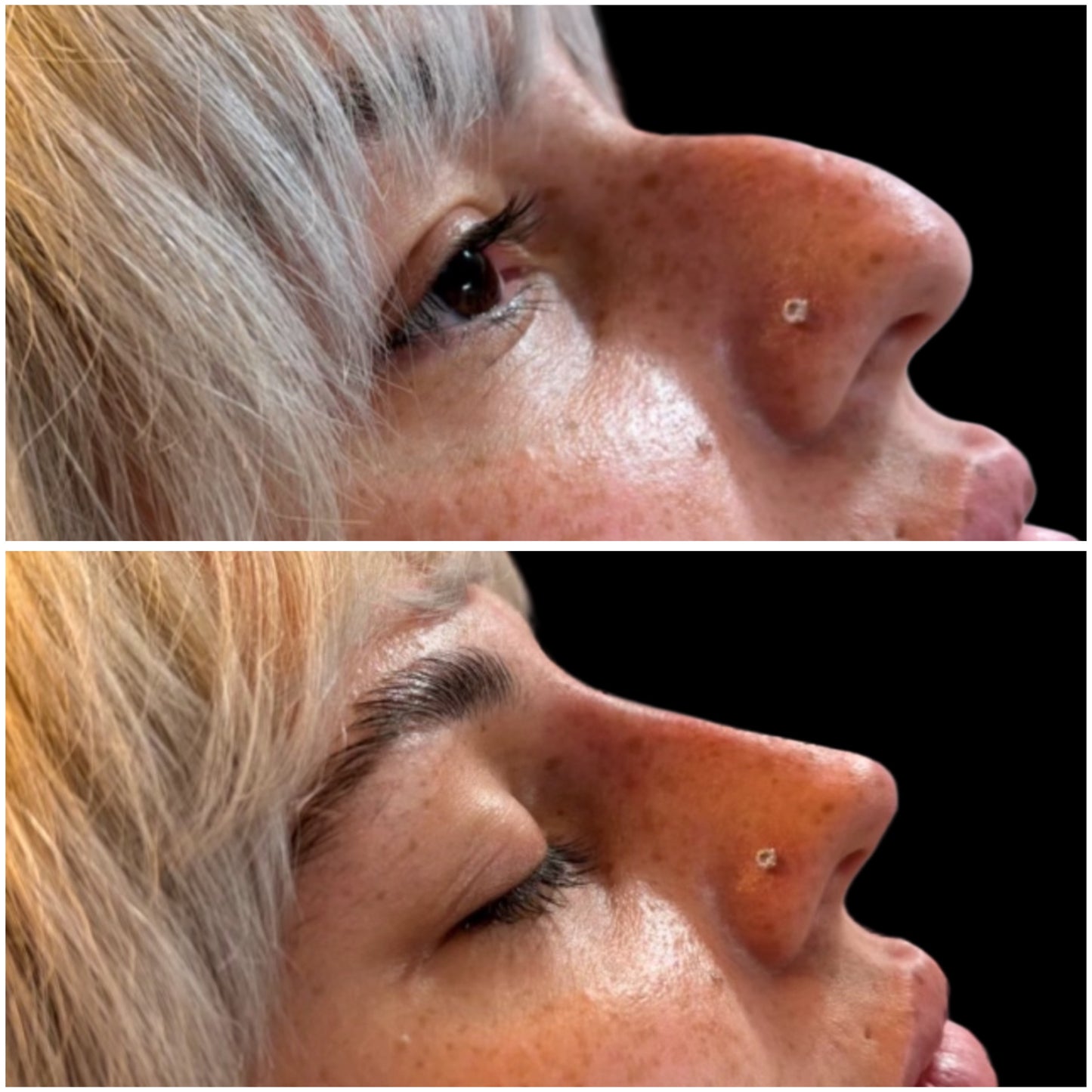 Nose filler Deposit