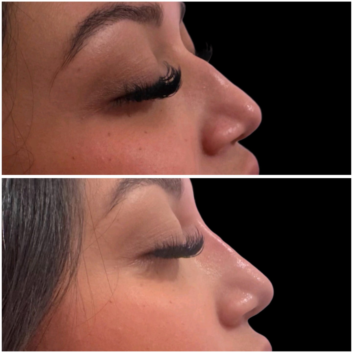 Nose filler Deposit