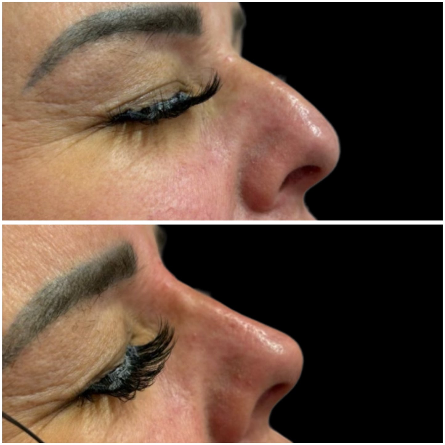 Nose filler Deposit