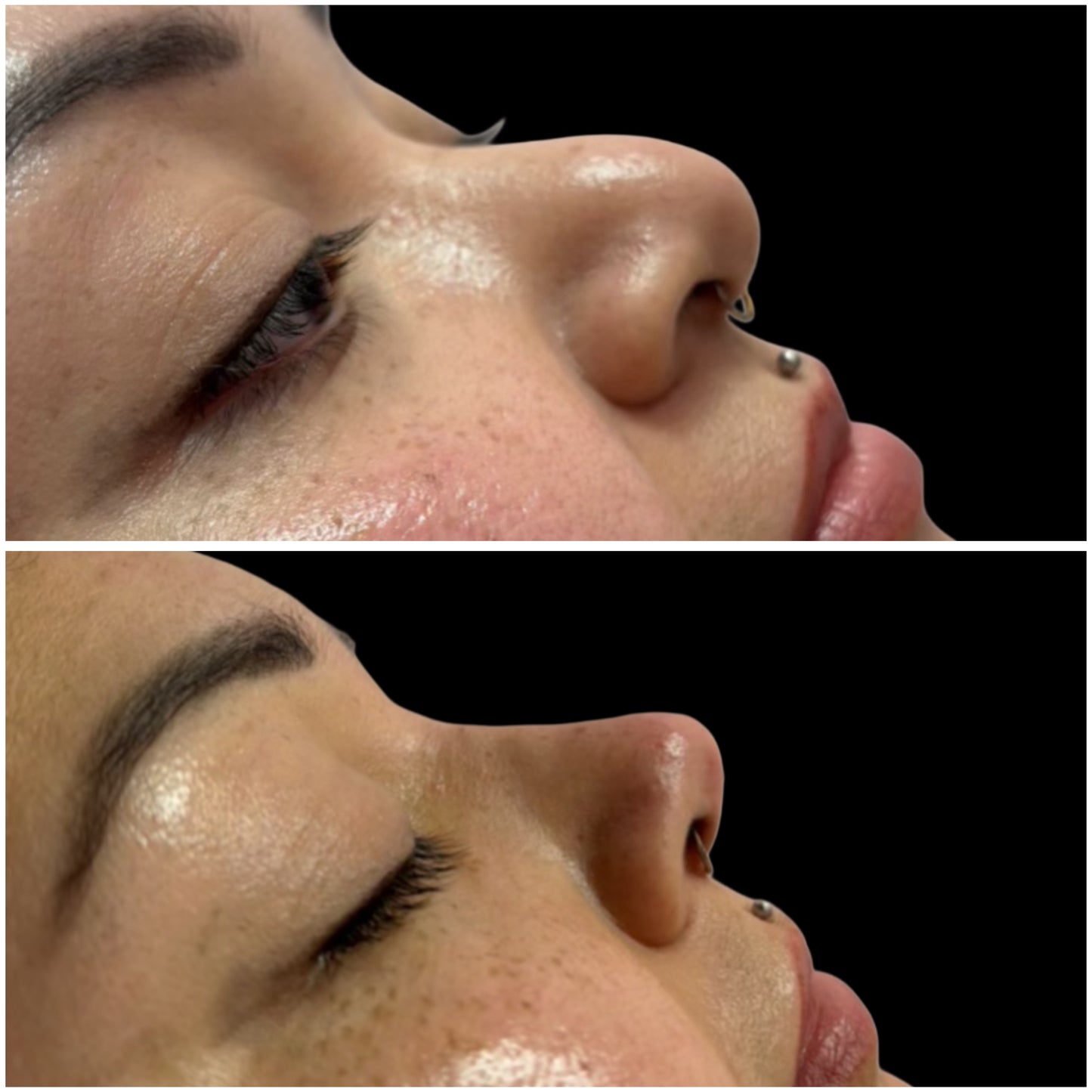 Nose filler Deposit