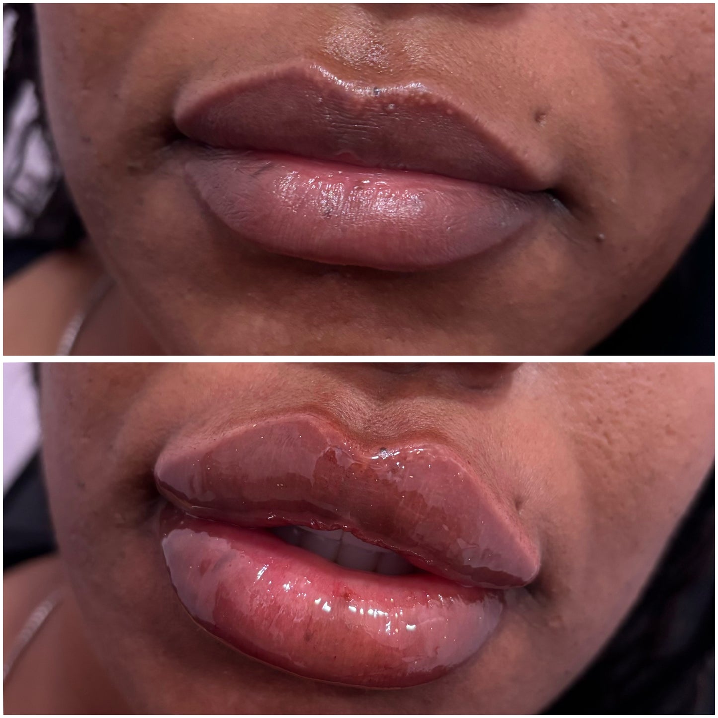 Lip Filler Deposit