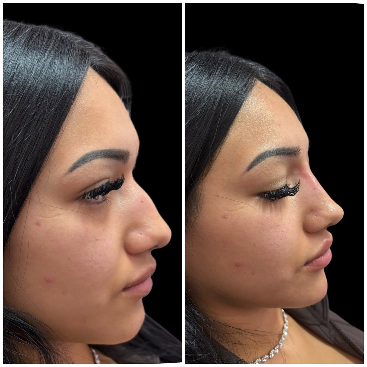 Nose filler Deposit