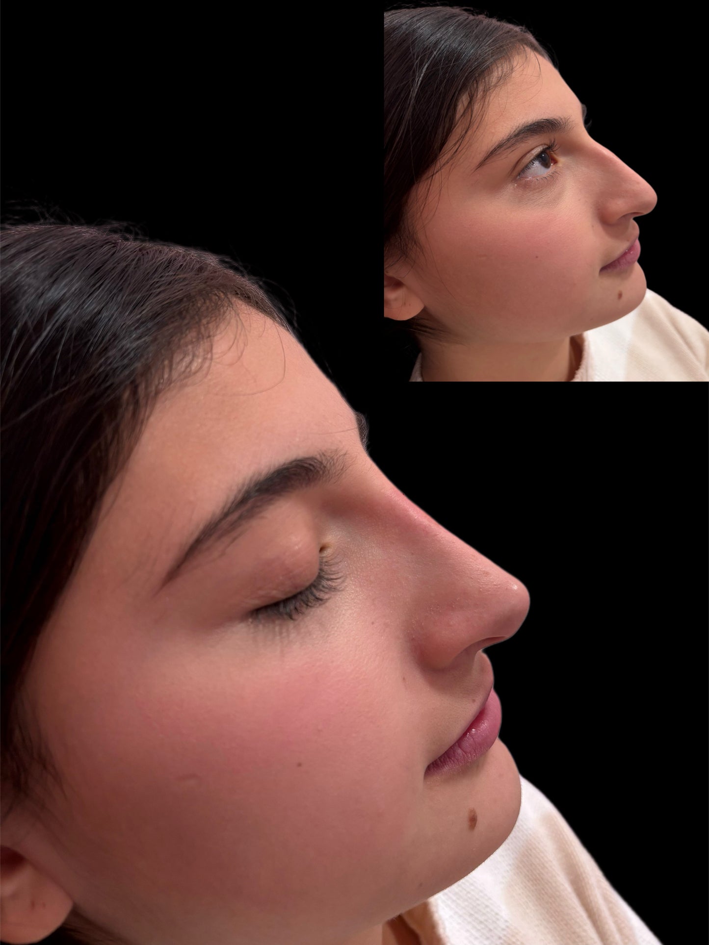 Nose filler Deposit